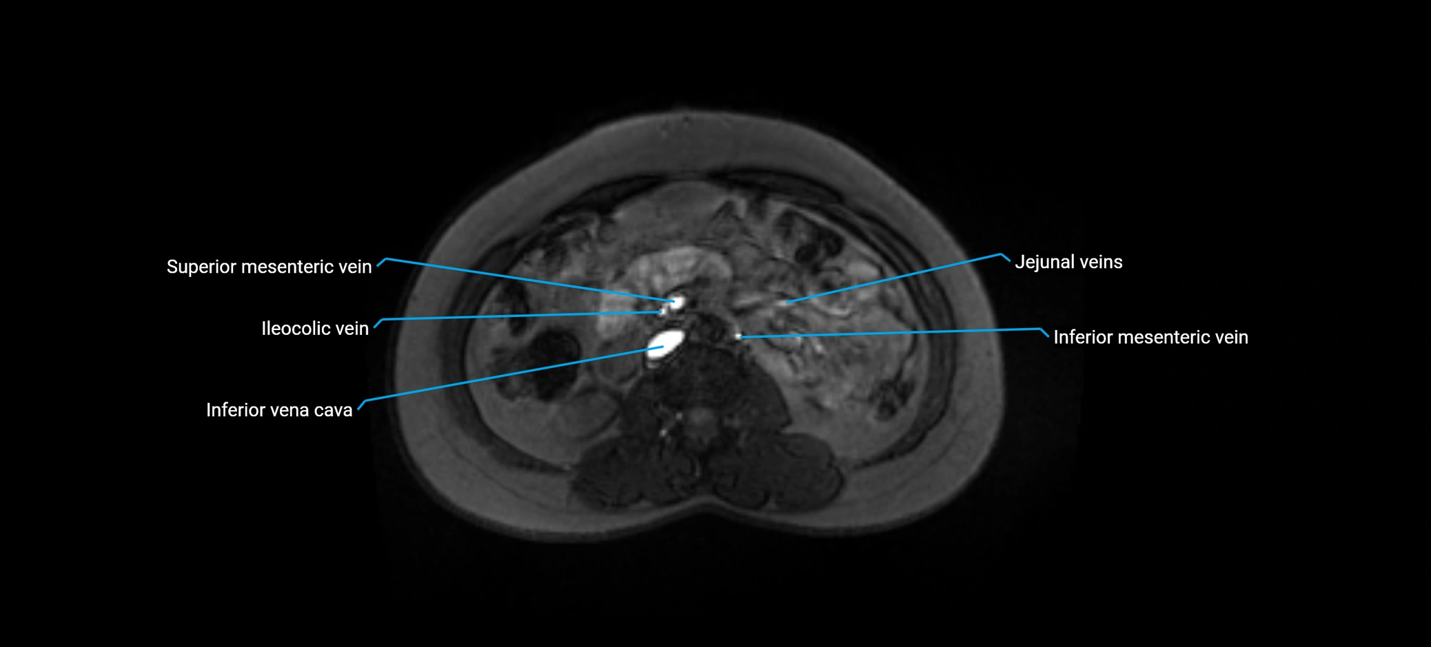 MRV abdomen pelvis & lower limb axial cross sectional anatomy labelled MRI image 85 (1).webp